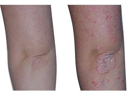 Psoriasis Eczema Vitiligo treatment USB lamp