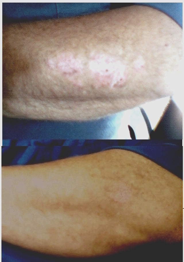 Psoriasis Eczema Vitiligo treatment USB lamp